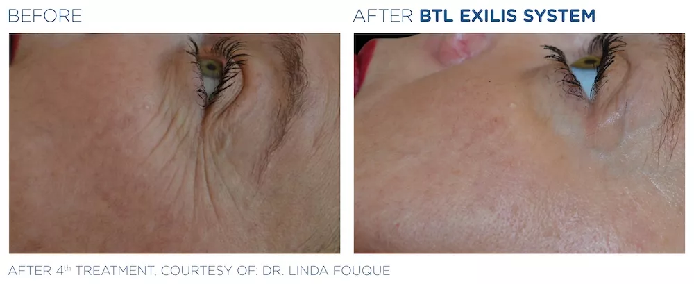 BTL_Exilis_system_PIC_Ba-card-female-eyes-021_EN100
