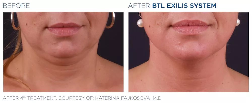 BTL_Exilis_system_PIC_Ba-card-female-face-025_EN100