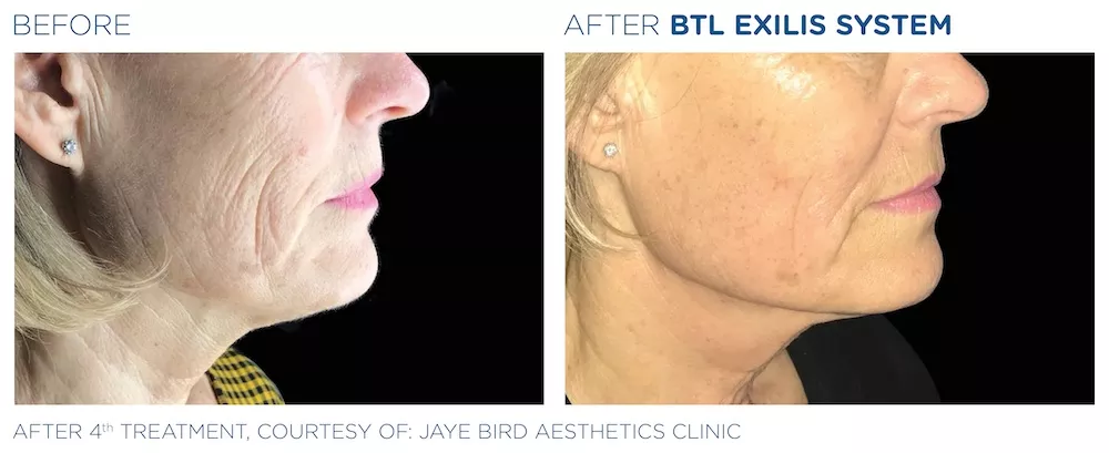 BTL_Exilis_system_PIC_Ba-card-female-face-neck-012_EN100
