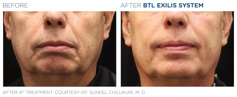 BTL_Exilis_system_PIC_Ba-card-male-face-020_EN100